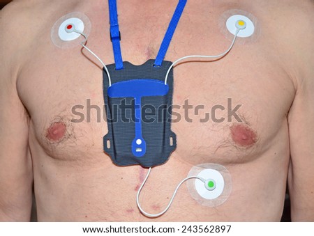 A portable heart monitor, with colour coded electrode pads. Worn by a man who has had open heart surgery, as seen from the scar tissue and tube holes on his sternum and chest