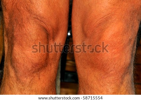 torn meniscus causes swelling around the left knee caused by sport;
