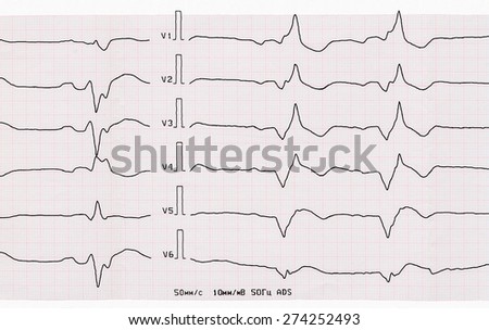 Emergency Cardiology. Tape ECG with acute period of macrofocal anterior myocardial infarction