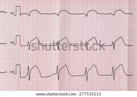 Emergency Cardiology. ECG with acute period macrofocal widespread anterior myocardial infarction