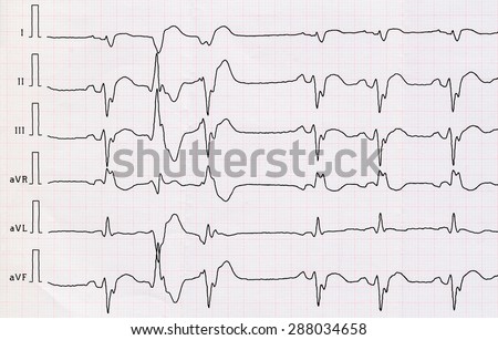 Tape ECG with acute period macrofocal widespread anterior myocardial infarction and pair ventricular premature beats