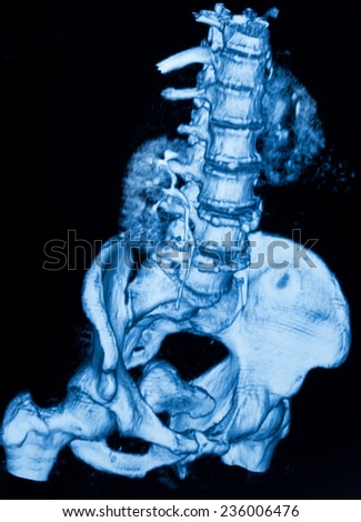 Image of CT scan renal and sacrum