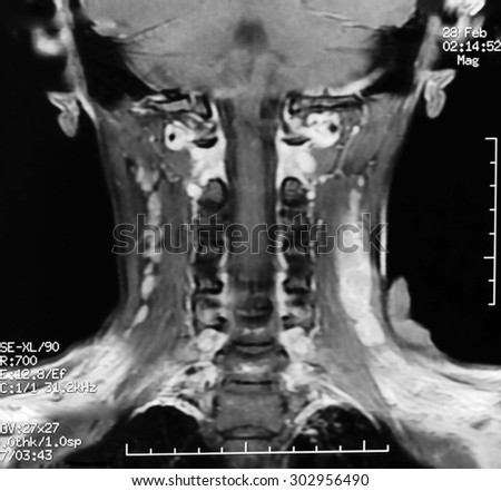 MRI Image of Cervical Vertebra.Radiology image for medical treatment.