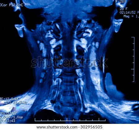 MRI Image of Cervical Vertebra in Blue tone.Radiology image for medical treatment.