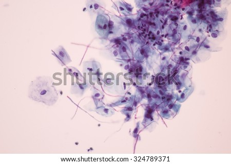 Candida albicans infecion in Pap smear.Medical background.