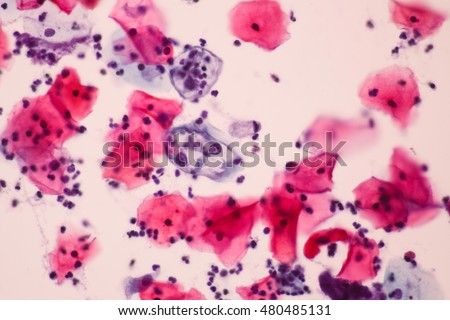 Abnormal squamous epithelial cells view in microscopy.HPV criteria for pap smear slide cytology.Koilocyte cells.Medical background.