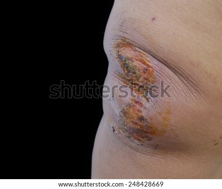 Wound of  knee caused by the accident on black background