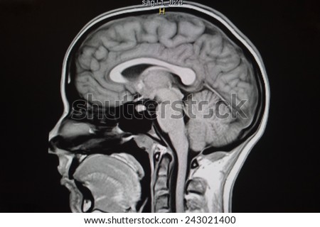sagittal T1 magnetic resonance image of brain