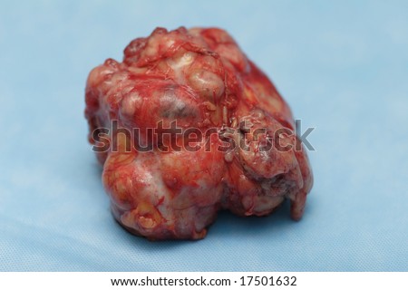 Big fibroadenoma (benign tumor) on section after operation