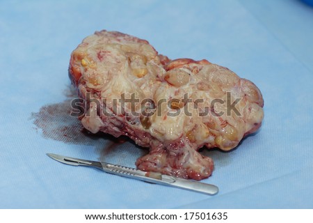 Benign tumor (fibroadenoma) on section after operation
