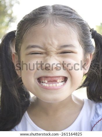 Kid with front teeth loss: A little girl showing front teeth loss with big smile