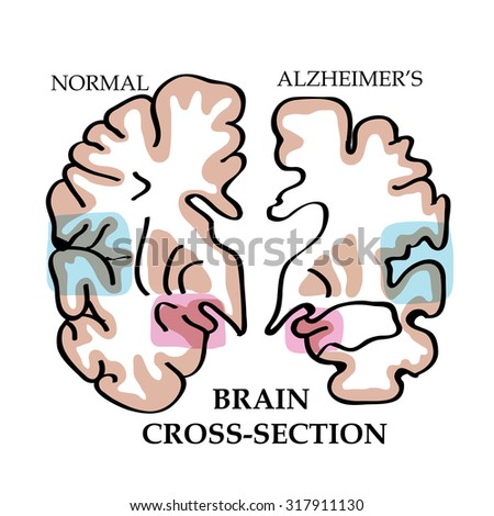 the fight for your brain alzheimer’s the fight for your brain alzheimer’s