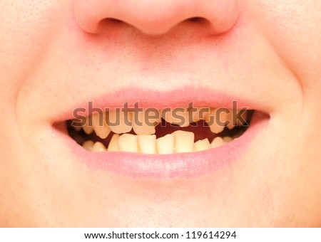 young man with a teeth broken and rotten