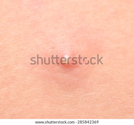 pimple on the skin close-up