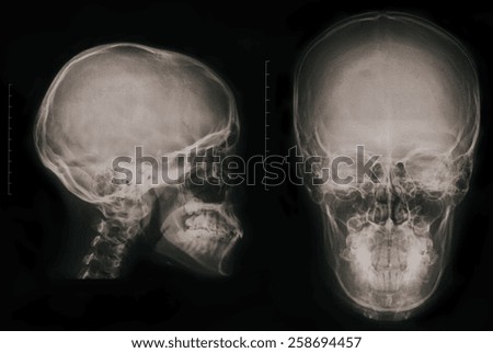 X-ray of a human skull from the front and profile