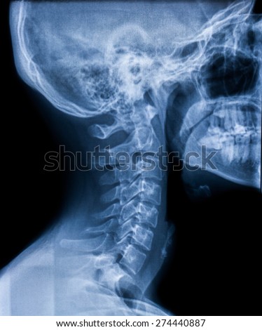 X-ray of neck injury a young man on a black background