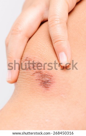 Wound on child knee from accident become dry on white background