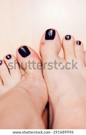 Female feet with blisters