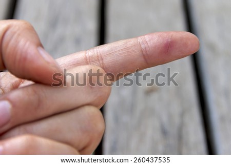 Cut on finger