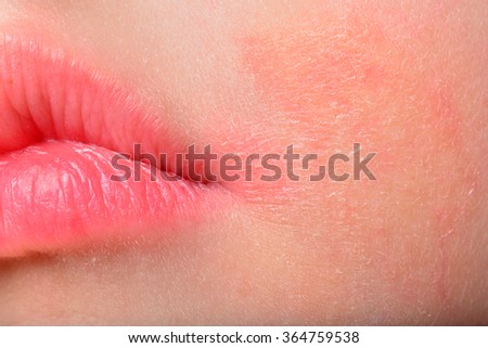 Atopic Dermatitis. Girl with atopic dermatitis symptom on skin of cheeks. Allergy concept