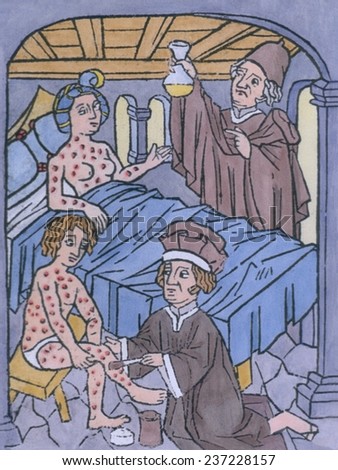 Syphilis In Europe A woman in bed and a man sitting on a stool are covered with venereal disease lesions, Woodcut with modern watercolor.