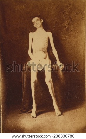 The Civil War, A Federal prisoner, returned from prison, standing, full-length, nude, facing front, photograph, 1861-1865.
