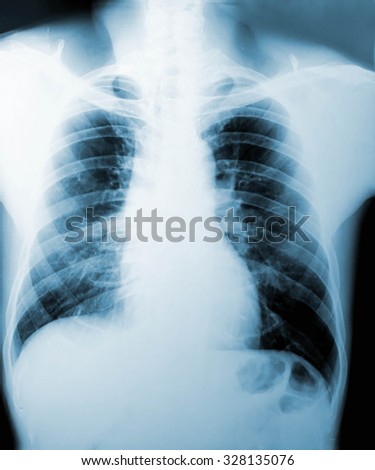X-Ray image, View of chest men for medical diagnosis.