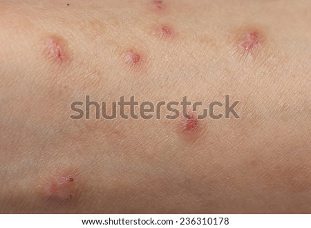 Allergic skin lesions on the arms Thailand Asian women.