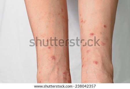 Itchy skin lesions from allergies, skin women.