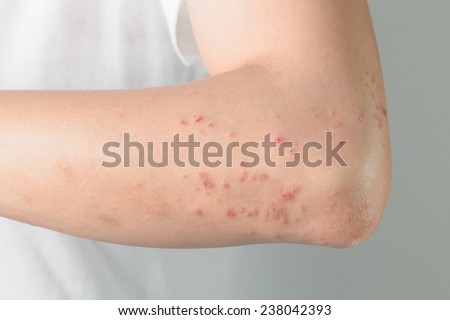 Itchy skin lesions from allergies, skin women.