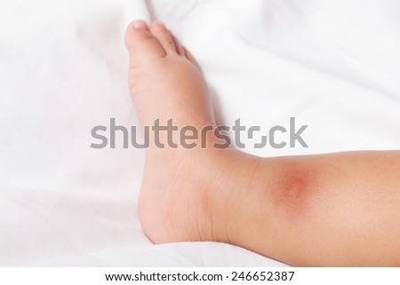 new born with multiple mosquito bites on arm, white background