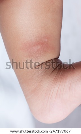 new born with multiple mosquito bites on leg, white background
