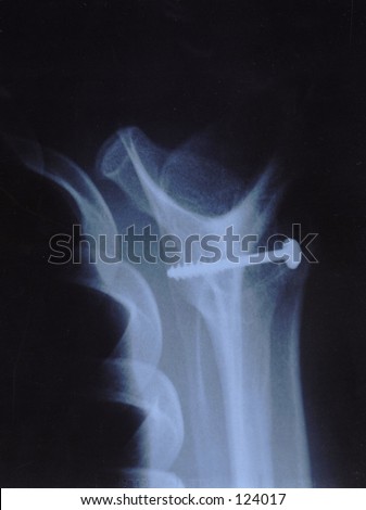 Screw blocks a part of bone transplanted from the clavicle, due to a usual dislocation of shoulder