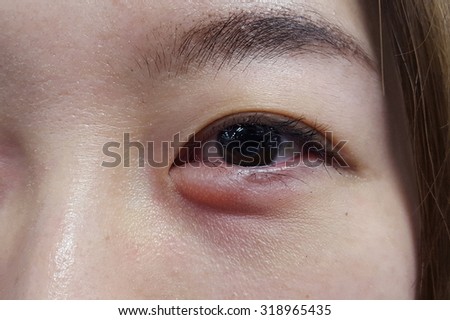 closeup on an allergy eye