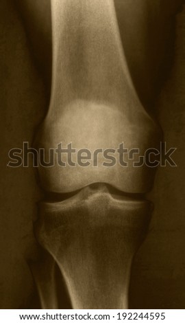 Lateral projection of a person\'s knee,  X ray image.
