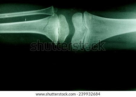 X-ray of a broken leg, fracture tibia