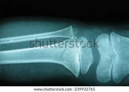 Film x-ray showing broken of knee bone