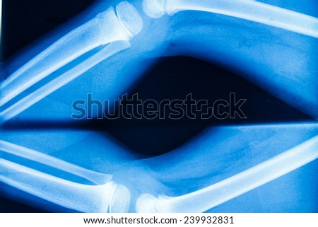 Film x-ray showing broken of knee bone