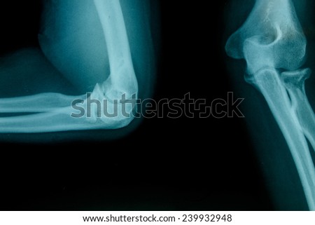 Film x-ray showing broken of elbow bone