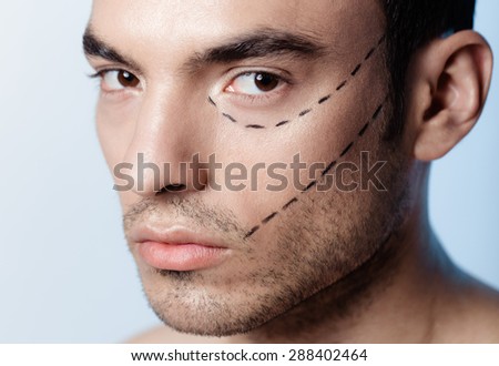 The man on the face is marked with guides before surgery filling wrinkles, crow\'s feet, injection of hyaluronic acid, plastic operation
