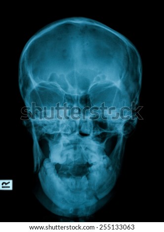 X-ray image of skull, frontal view