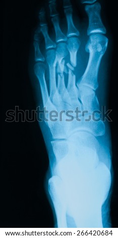 x-ray image of  foot, oblique view, show fracture of the second and third metatarsal