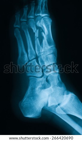X-ray image of  foot, oblique view, show fracture of the second and third metatarsal