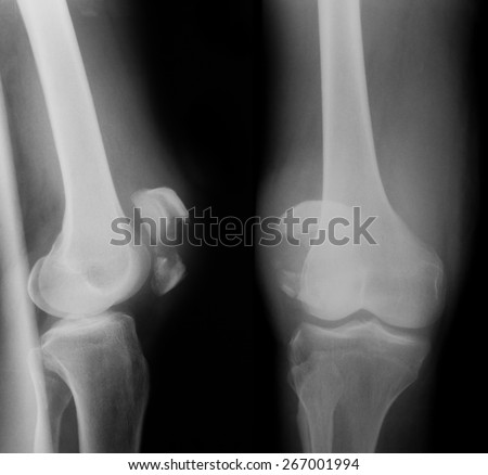 X-ray image of broken knee, AP and lateral view, show broken of patella