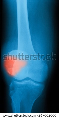 X-ray image of knee joint, AP view, show broken of patella