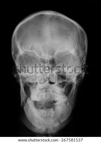 X-ray image of  broken  skull, AP view.