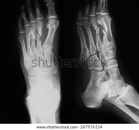X-ray image of foot, AP and oblique view, show fracture of the second and third metatarsal bones.