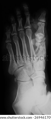 X-ray image of broken foot, oblique view,  show fracture of 1th metatarsal bone