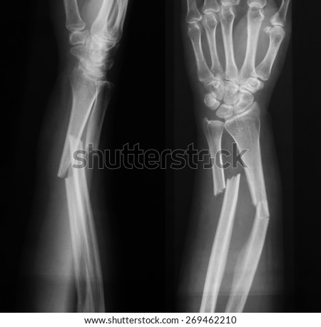 X-ray image of broken forearm, AP and lateral view, show fracture of ulna and radius.
