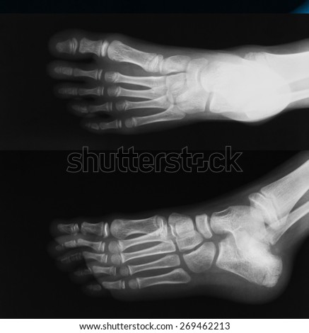 X-ray image of foot, AP and oblique view, show fracture of calcneus and toe